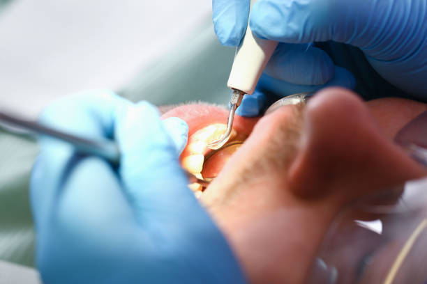 Best Emergency Dentist for Lost Fillings or Crowns in Denair, CA